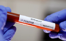 Azərbaycanda daha 49 nəfərdə koronavirus aşkarlandı - 1 nəfər vəfat etdi, 62 nəfər sağaldı